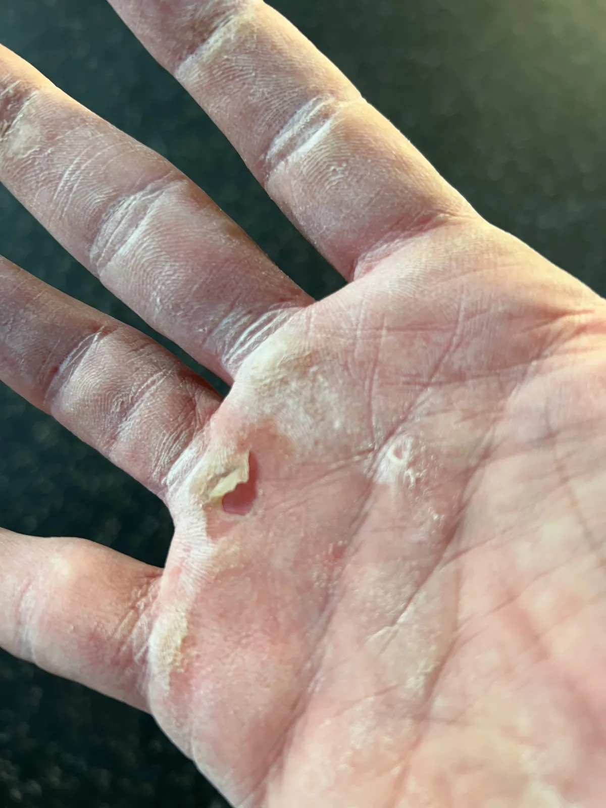 La mia mano dopo lo stacco, con il callo strappato
